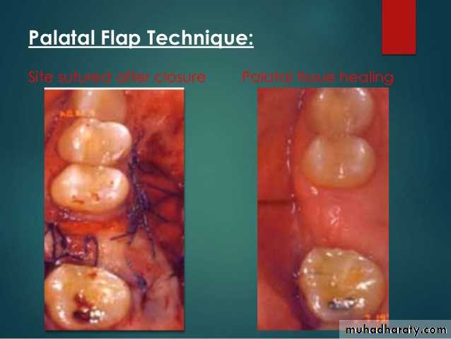 maxillary sinus disease