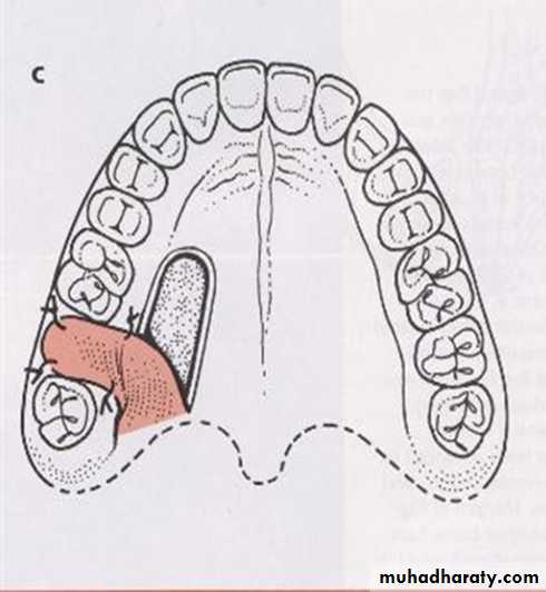 maxillary sinus disease