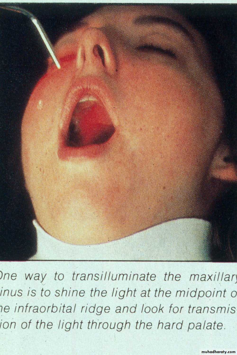 maxillary sinus disease