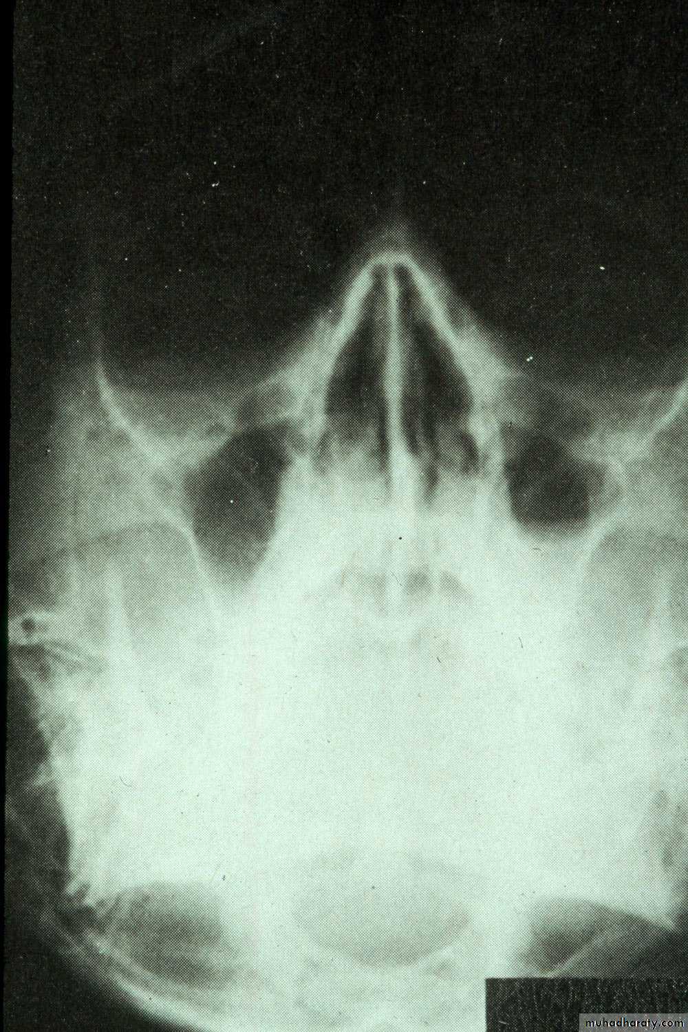 maxillary sinus disease