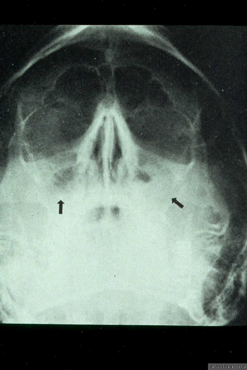 maxillary sinus disease