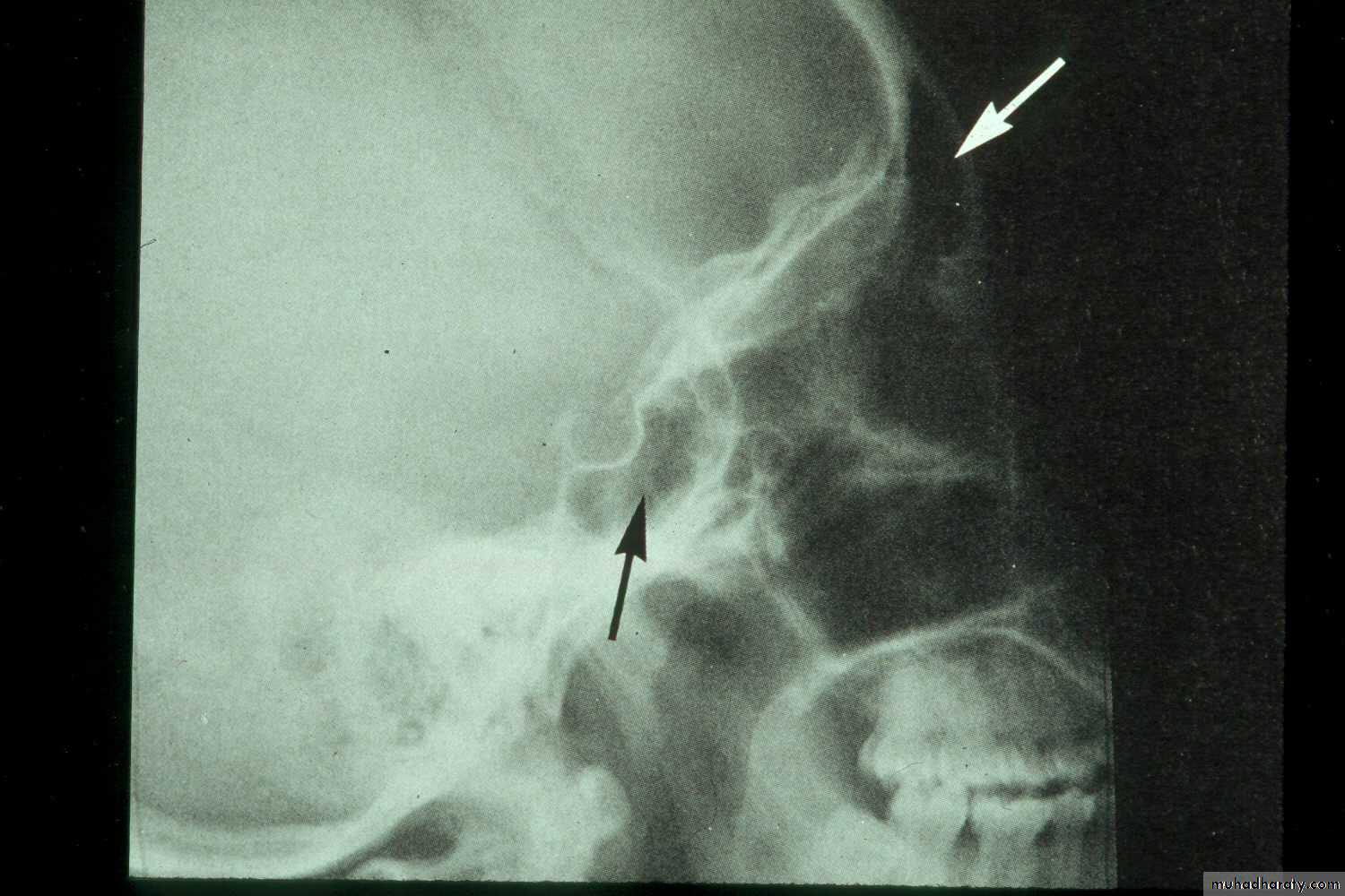 maxillary sinus disease