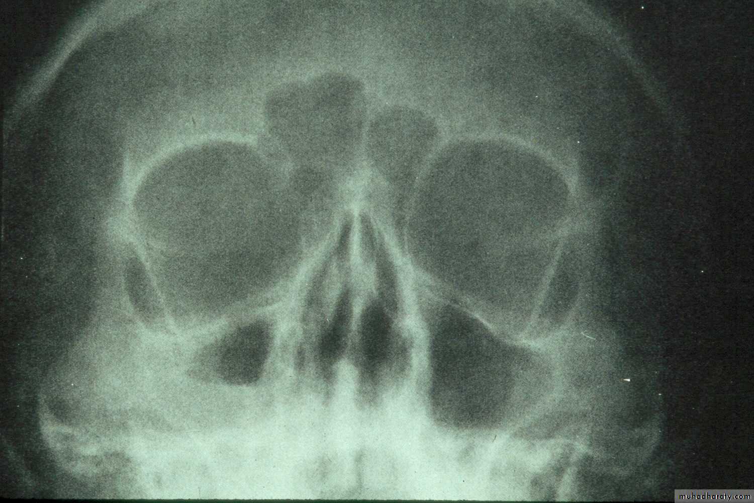 maxillary sinus disease