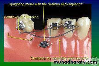dental implant 2