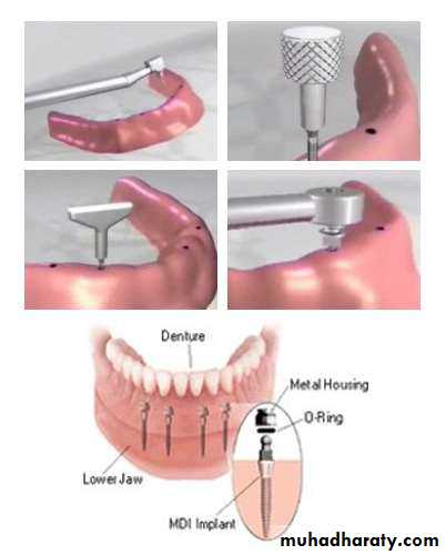dental implant 2