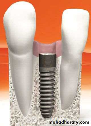 dental implant 2
