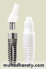 dental implant 2