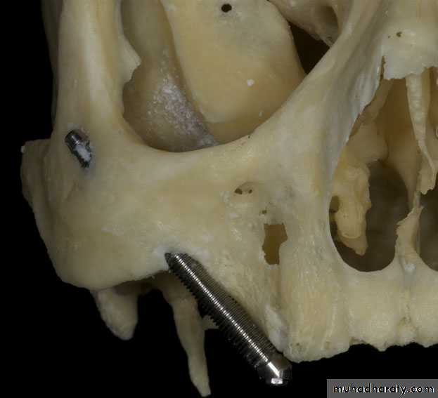 dental implant 2