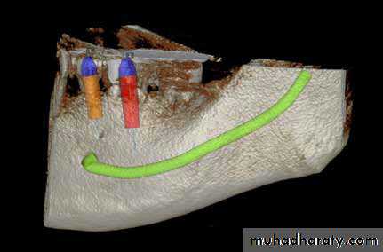 dental implant 2