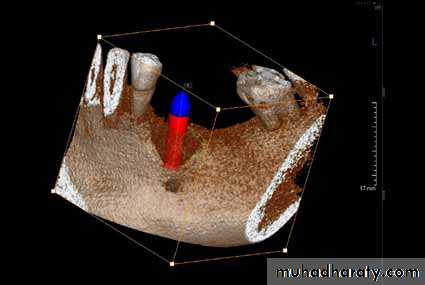 dental implant 2