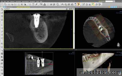 dental implant 2