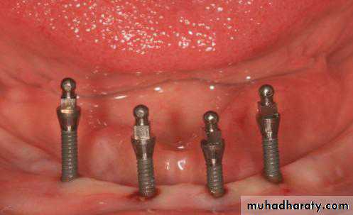 dental implant 2