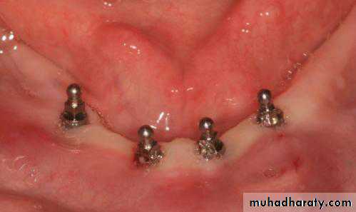 dental implant 2