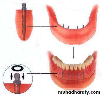 dental implant 2