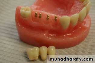 dental implant 2