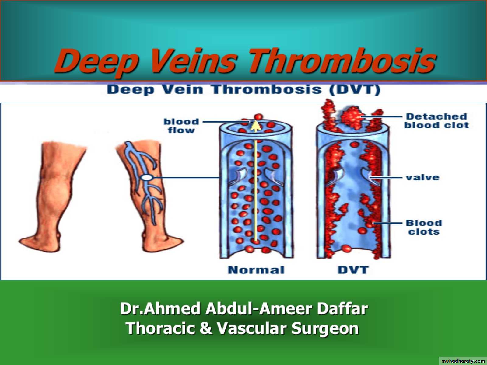 DVT