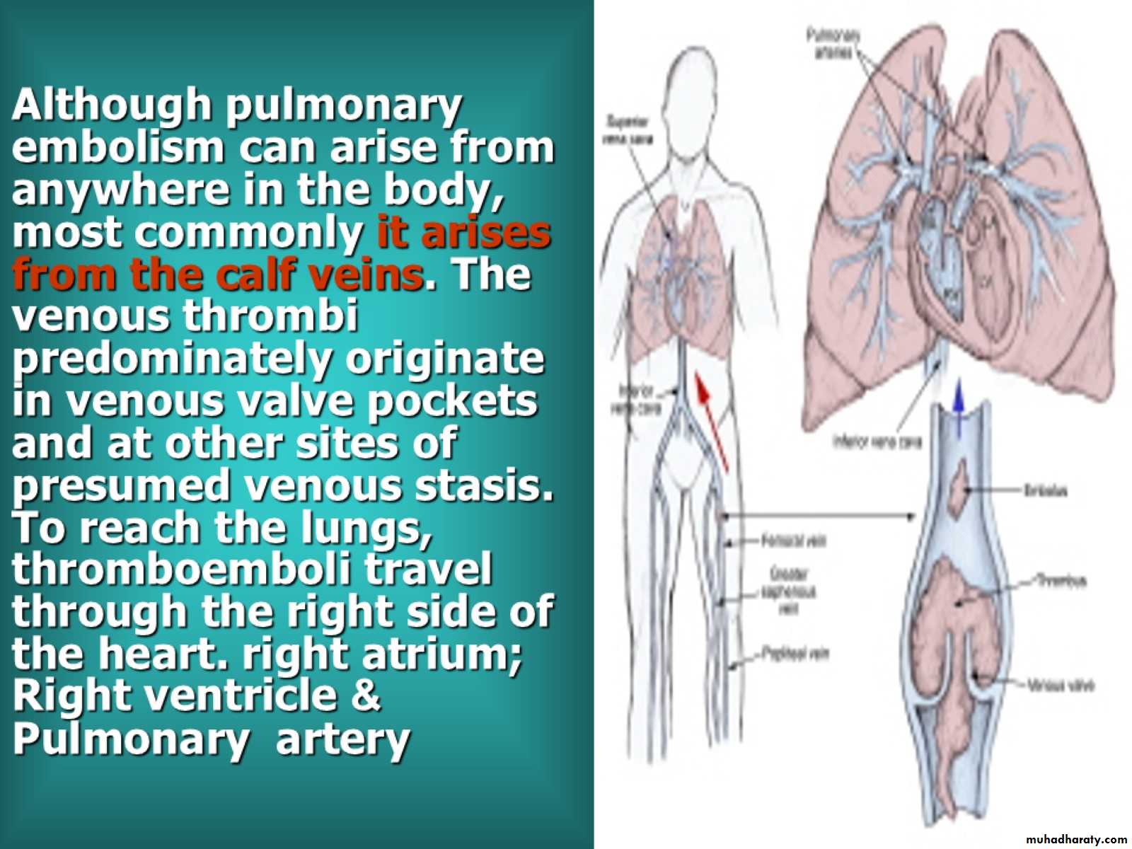 DVT