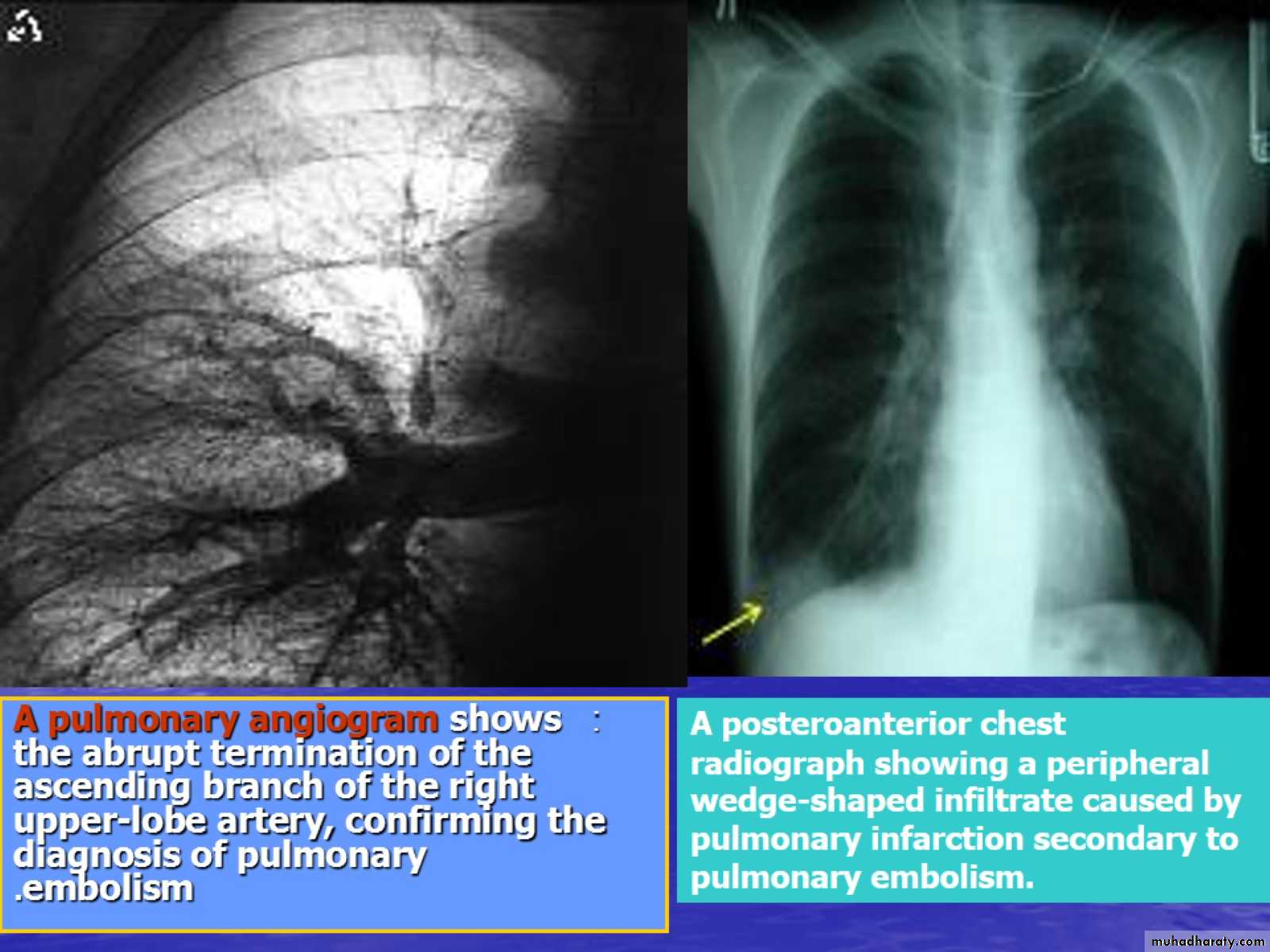 DVT
