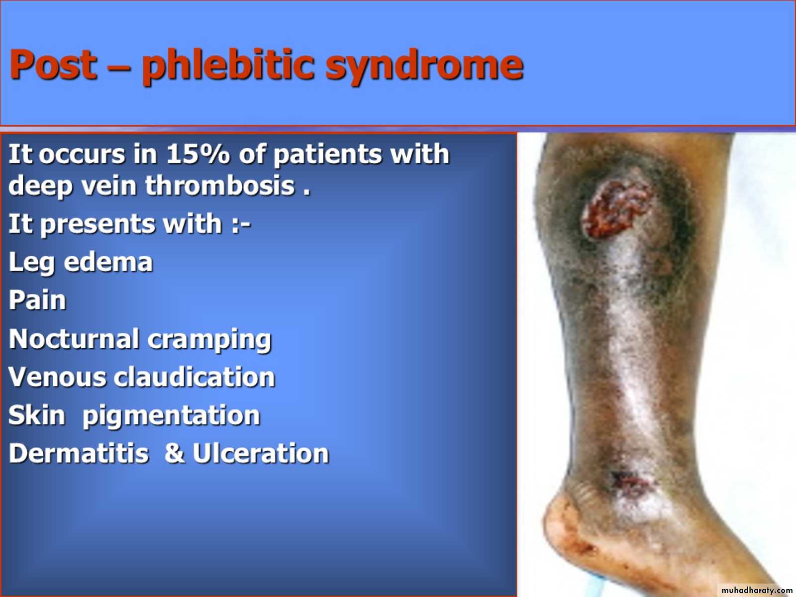 DVT