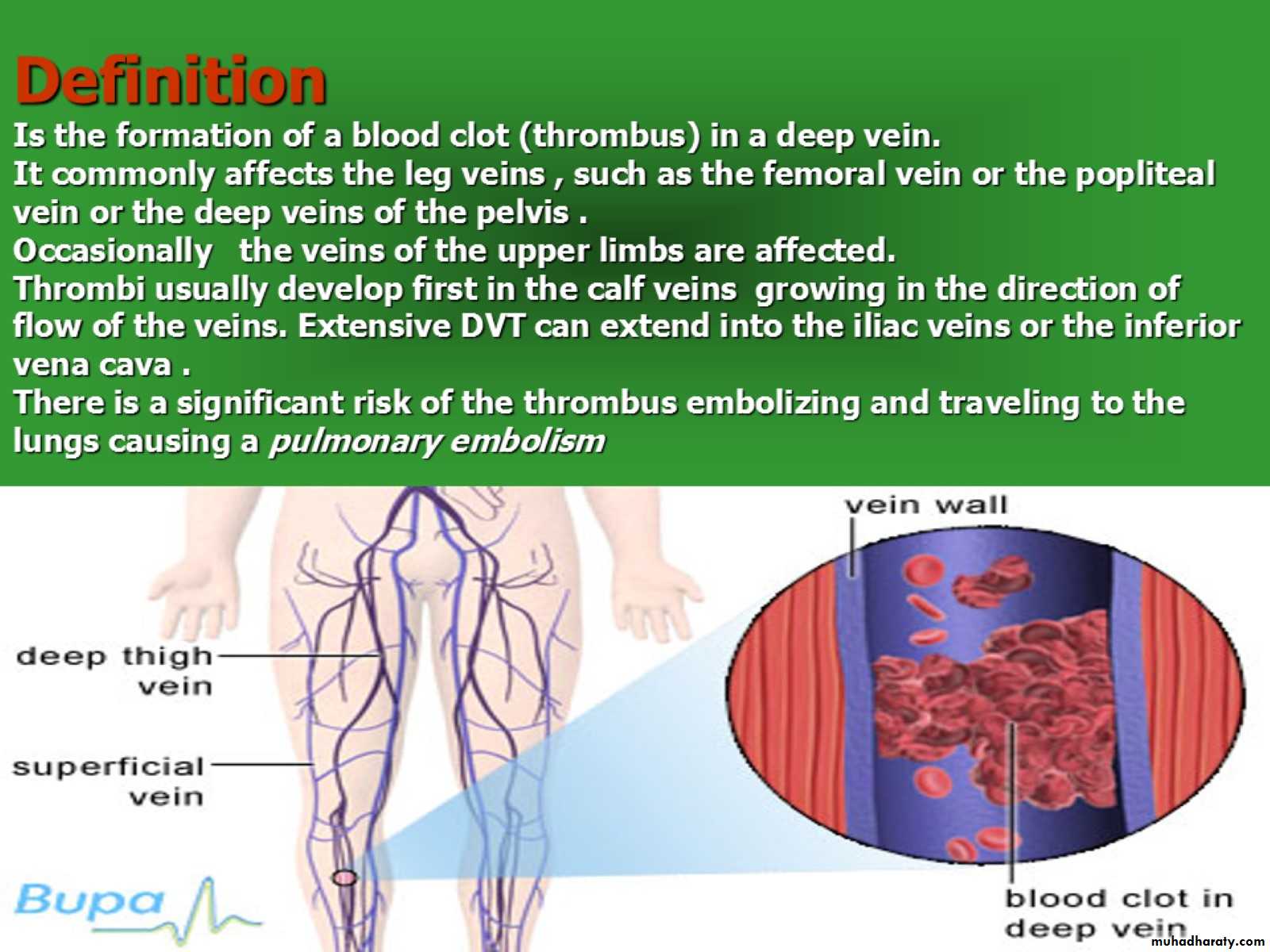 DVT