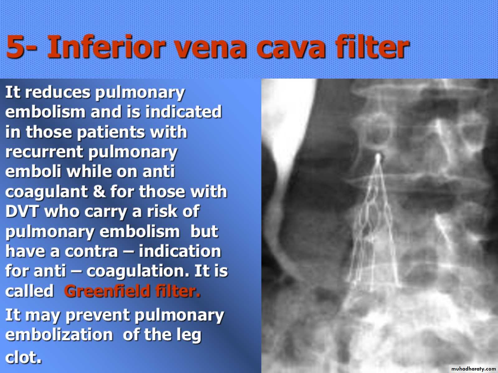 DVT