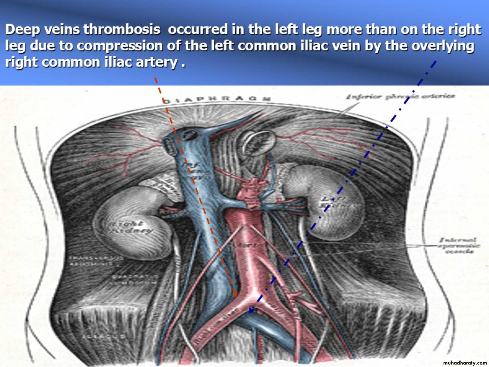 DVT