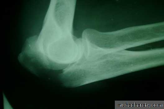 Orthopedics Principle of Fractures