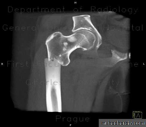 Orthopedics Principle of Fractures