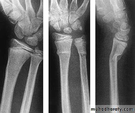 Orthopedics Principle of Fractures