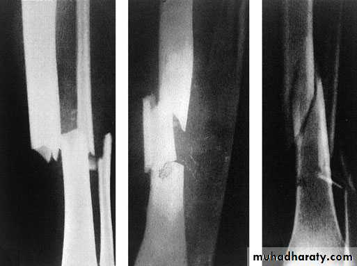 Orthopedics Principle of Fractures