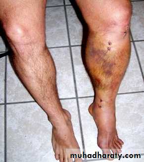 Orthopedics Principle of Fractures