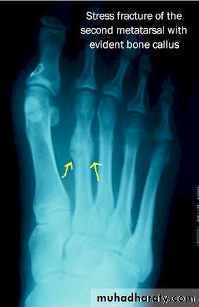Orthopedics Principle of Fractures