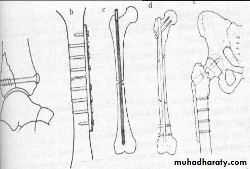 Orthopedics Principle of Fractures