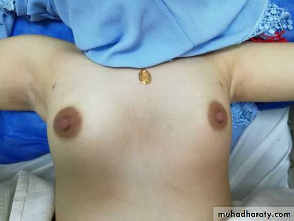 Breast Diseases