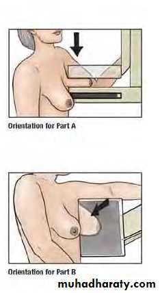 Breast Diseases