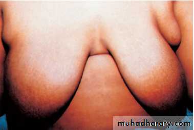 Breast Diseases