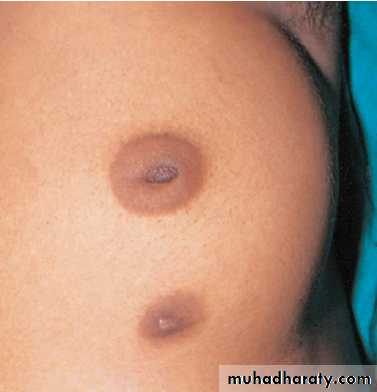 Breast Diseases