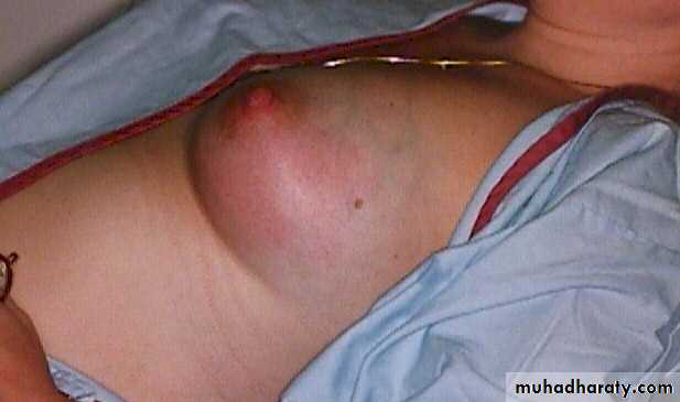 Breast Diseases
