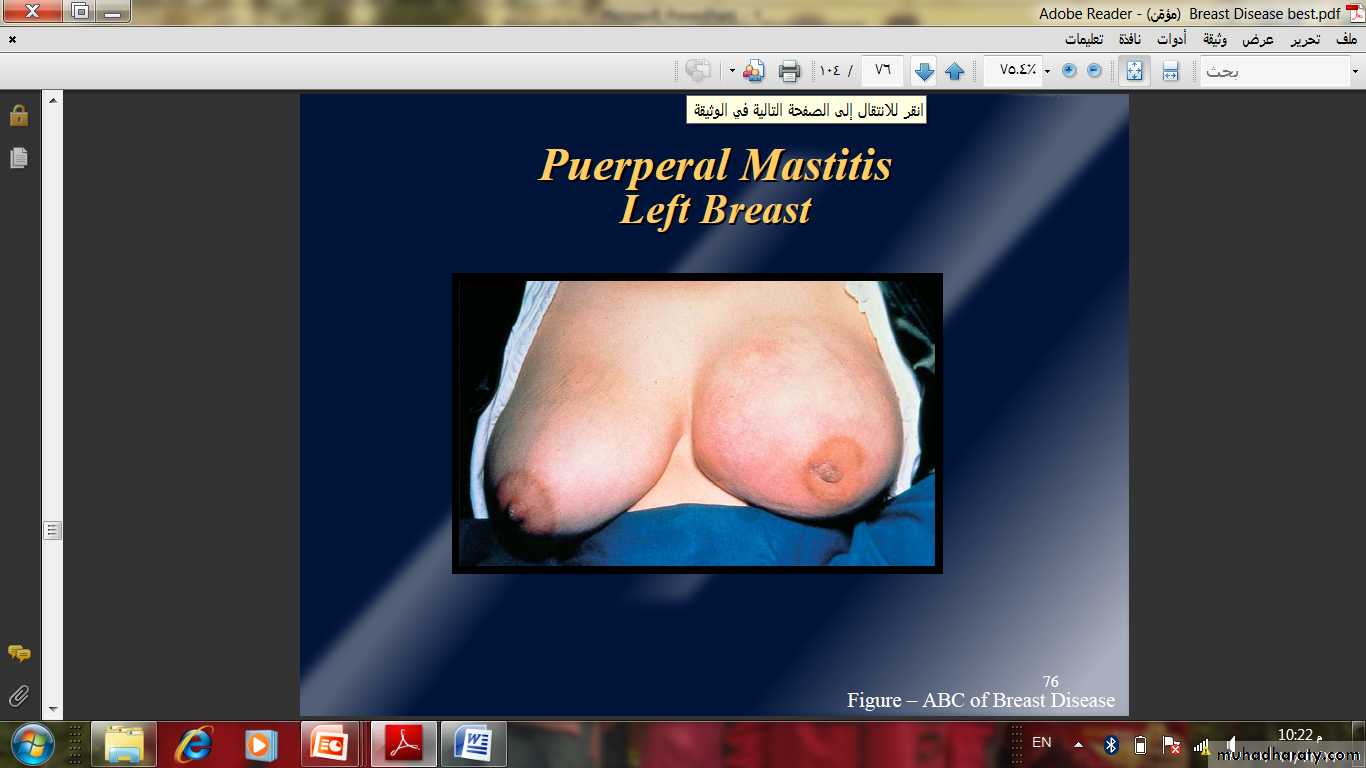 Breast Diseases