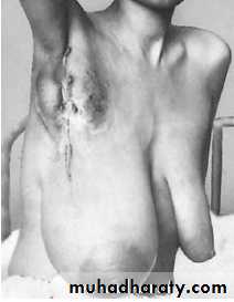 Breast Diseases