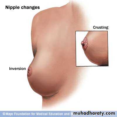 Breast Diseases