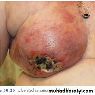 Breast Diseases