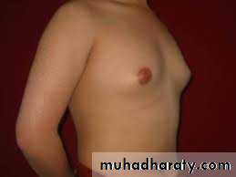 Breast Diseases