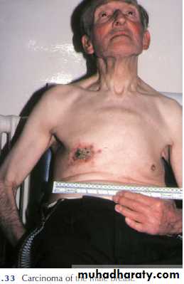 Breast Diseases
