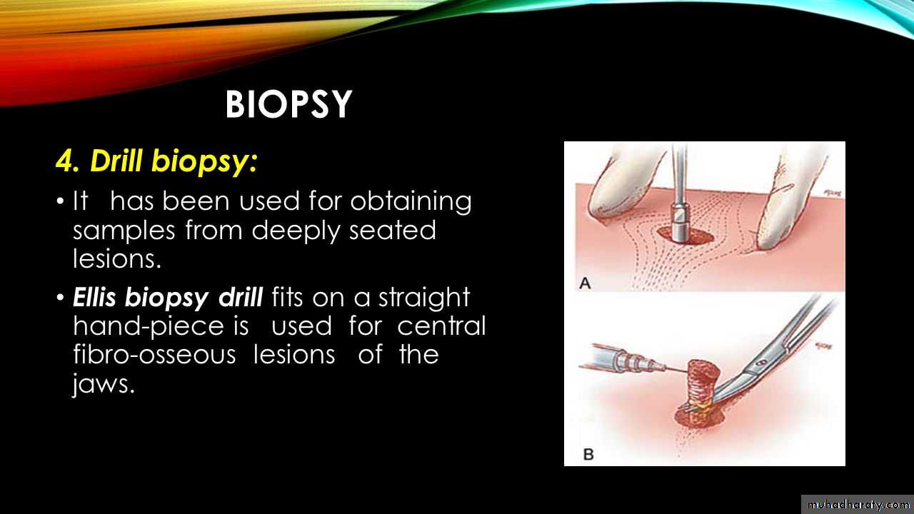 biopsy
