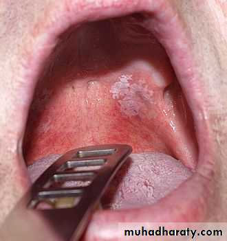 biopsy