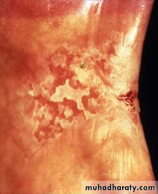 biopsy