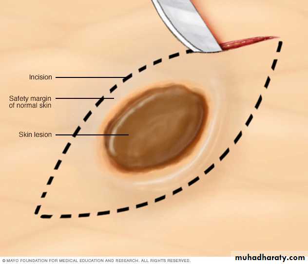 biopsy