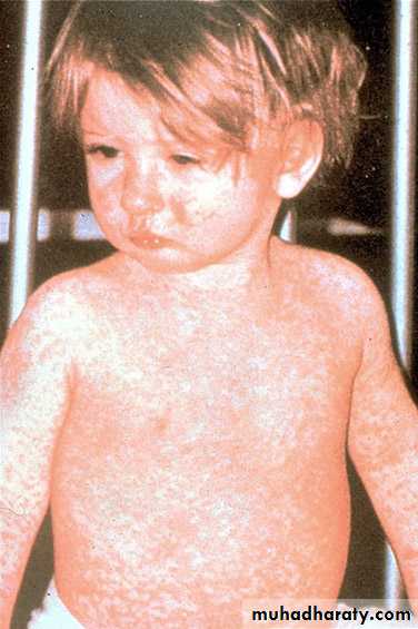 Measles