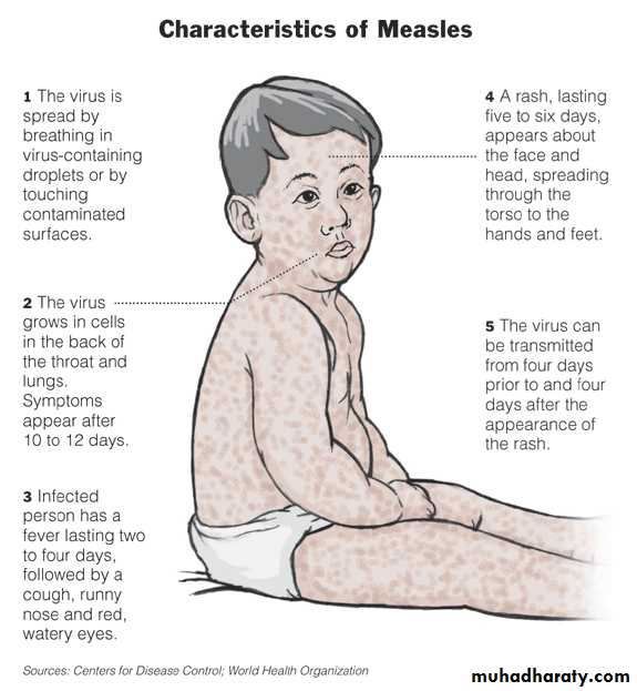 Measles